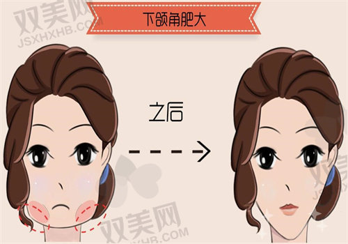 杭州陈小平面部轮廓手术价格表