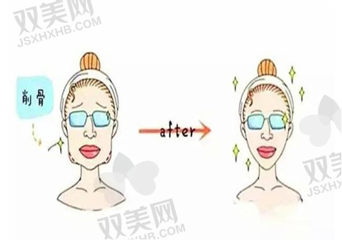 杭州陈小平面部轮廓手术好