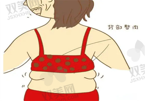 冯斌医生腰腹环吸手术费用