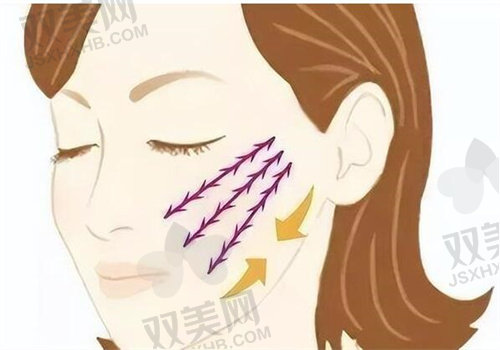 果肌复位术具体术式解析
