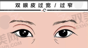 双眼皮17 (2).png