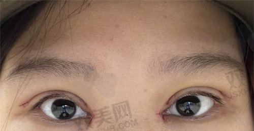 北京嘉禾整形李燕双眼皮病例