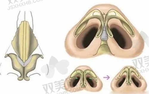 杨万忠医生隆鼻手术怎么预约