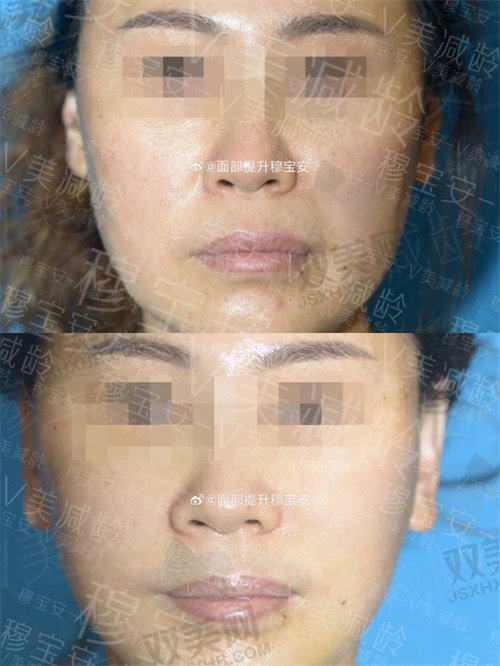 北京加减美医疗美容穆宝安面部提升病例