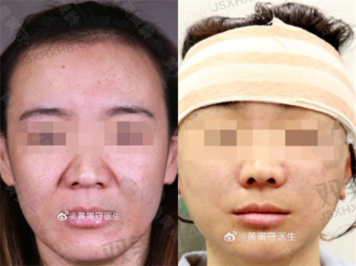 北京加减美医疗美容黄寅守面部提升术后即刻结果