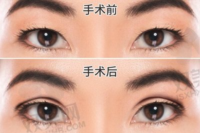 金奇龙双眼皮做得好吗