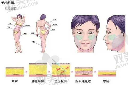 成都军大整形医院抽脂技术好的医生有哪些