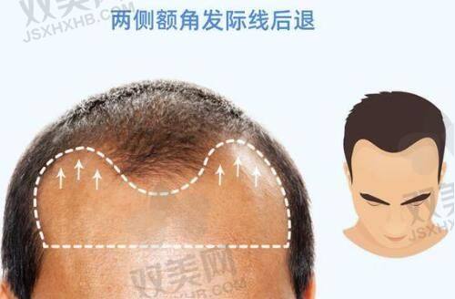 我来分享啦！搞懂法令纹是哪里位置和图解，艾莉薇填充法令纹效果超棒！
