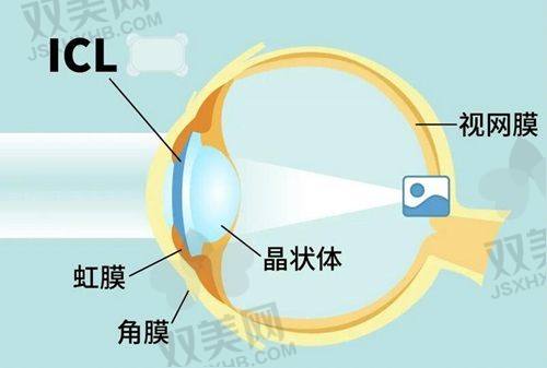 一、全飞秒SMILE近视手术价格：18800元起，真香警告！