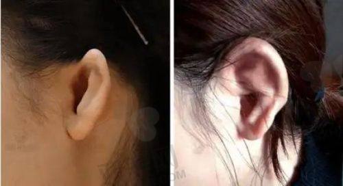 揭秘爱塑美、艾美、艾维岚等童颜针：适用部位、维持时间、复配方法及价格