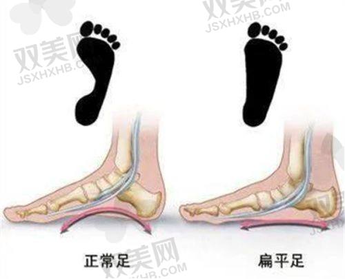 四、拇外翻不是“美容手术”！这些人十分有必要解决！