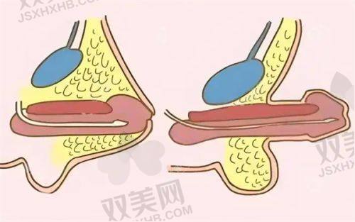 私密激光嫩红多少钱？一次价格、维持时长、效果及副作用全揭秘