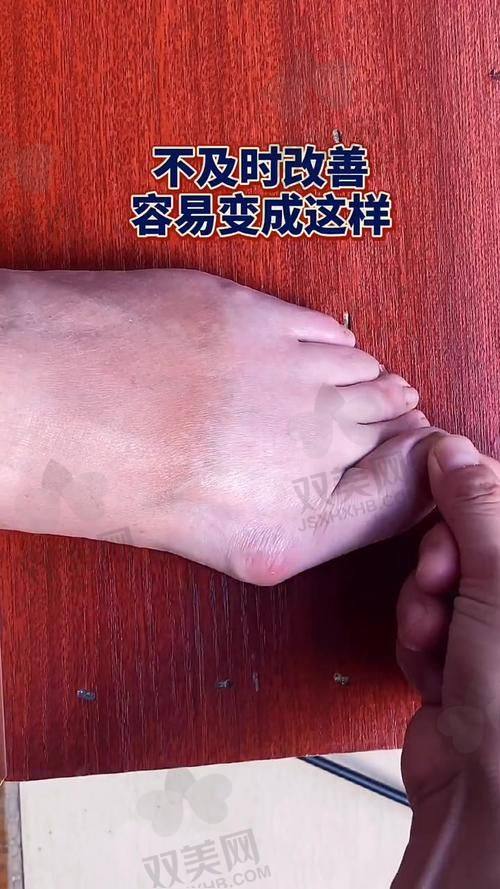 一、拇外翻微创手术到底多少钱？苏敬达医生真实价格大起底！