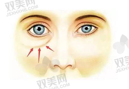 我注射玻尿酸后肿得厉害，肿胀期多久？又该怎么快速消肿？分享我的应对体验