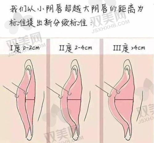 深圳千氧私密整形收费具体分析