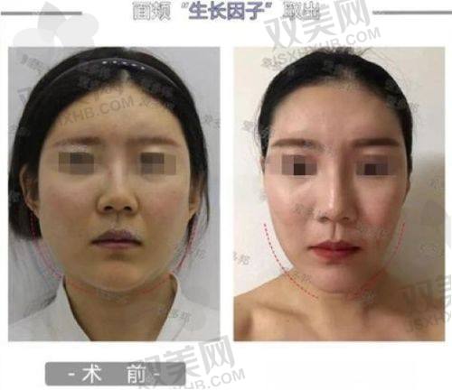 腰腹吸脂后束身衣要穿多久