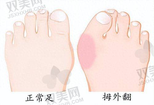 医美注射去除抬头纹、川字纹和法令纹