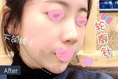 填充脸部的修复时间要多久