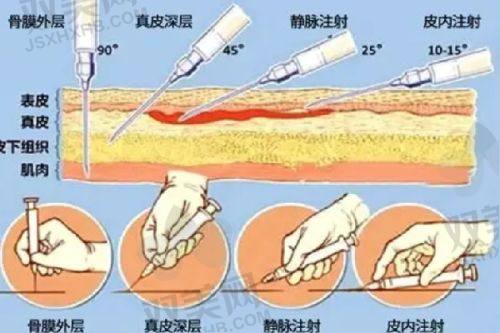 玻尿酸钠用于膝盖注射的作用与功效