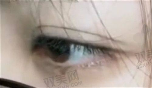 后遗症
