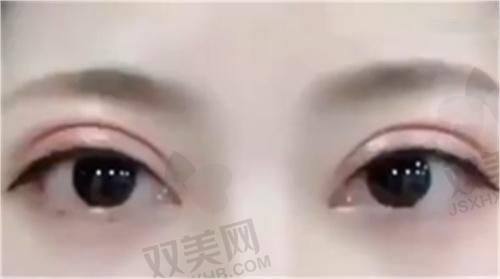 激光治疗改善抬头纹等纹路