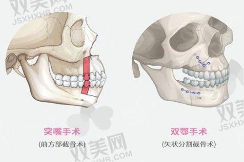 不同面部填充方式的成效