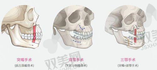 如生天使到底能不能打要打几次？能打，具体打几次要根据注射部位来决定