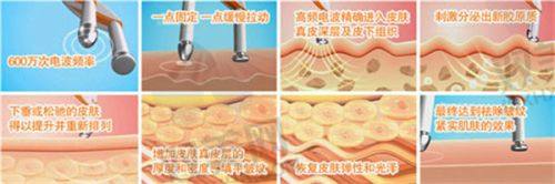 使用玻尿酸钠的注意事项
