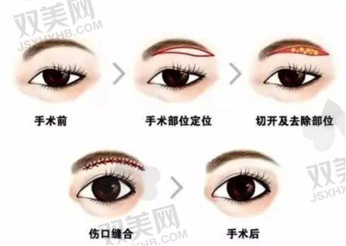 玻尿酸钠在滴眼液中的作用与功效