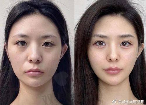 一、润致玻尿酸到底有几款？型号全览大公开