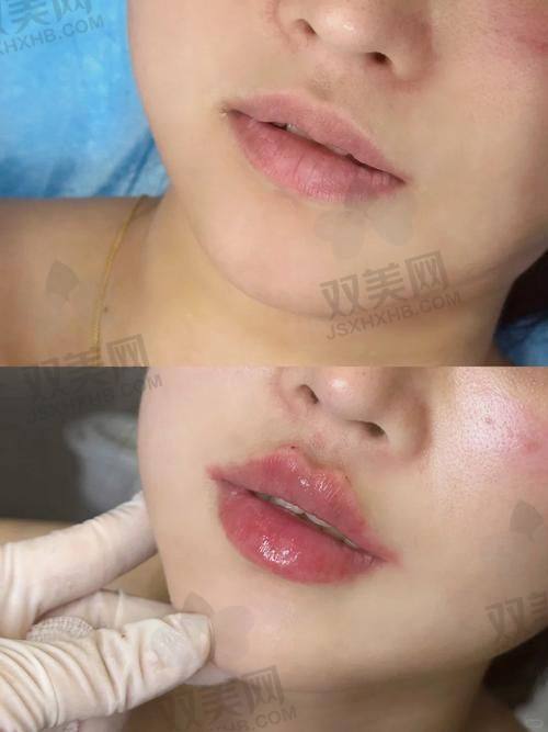 三、不同部位该选哪一款润致玻尿酸？选错成效大打折！