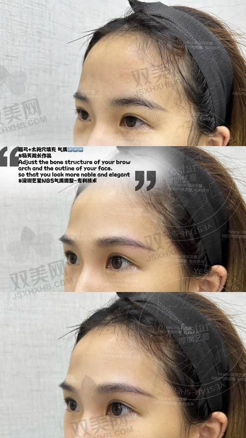 二、重点解析：为什么润致5号被称作“面部骨相改造王”？