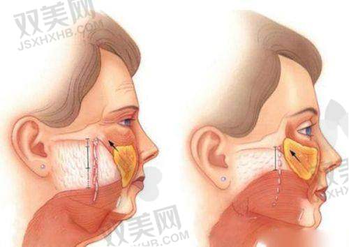 与其他医美项目的对比