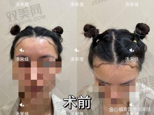 【荆州青逸美植发医院是正规的吗】