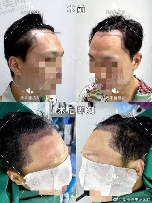 【荆州青逸美植发医院怎么预约挂号】