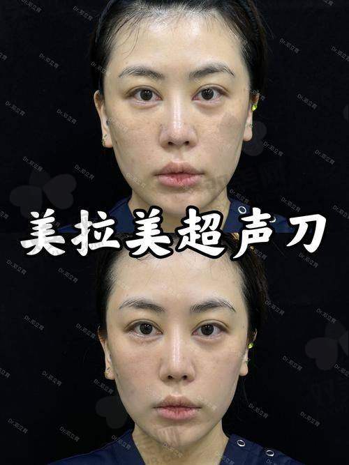 超声炮的仪器成本分析