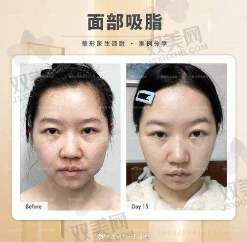 面吸后修复慢是哪些因素造成的？