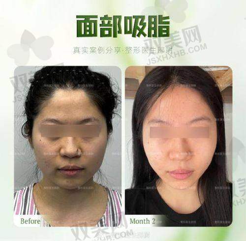 面吸后没成效该如何解决？