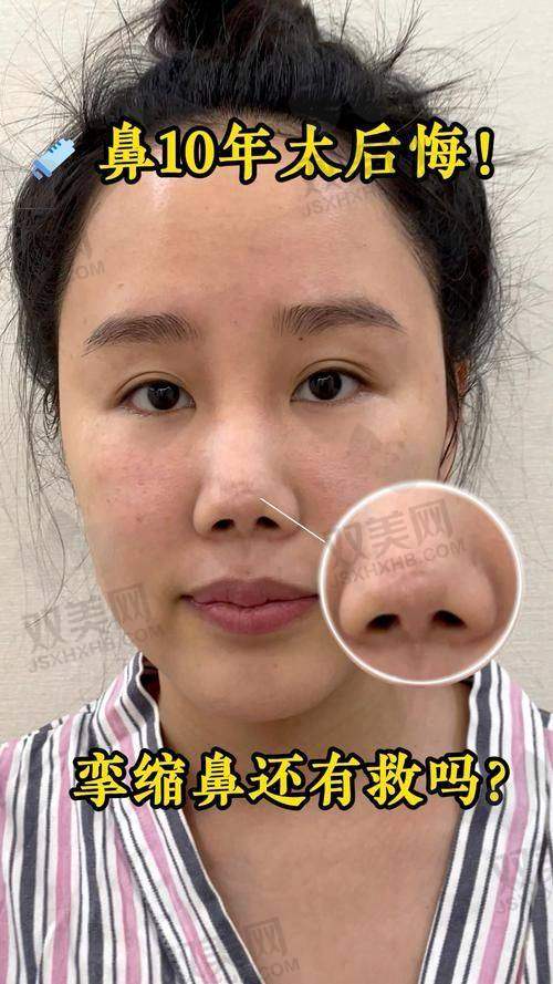 如何判断稀洛因馒化针是否正规