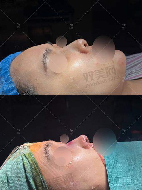 注射稀洛因馒化针的注意事项