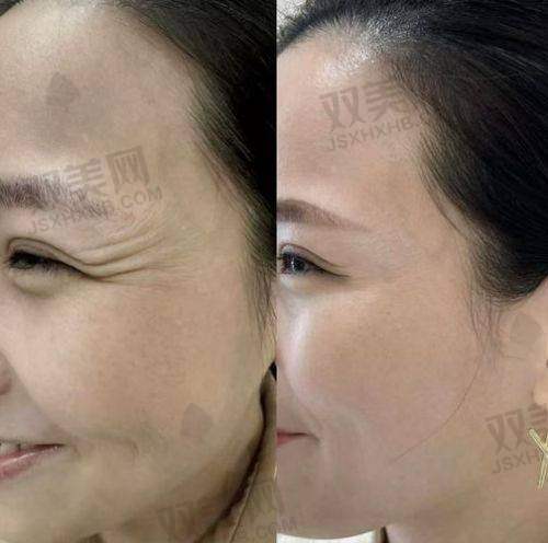 稀洛因馒化针与正规医美的差距