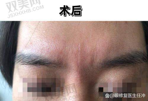 稀洛因馒化针产地分析