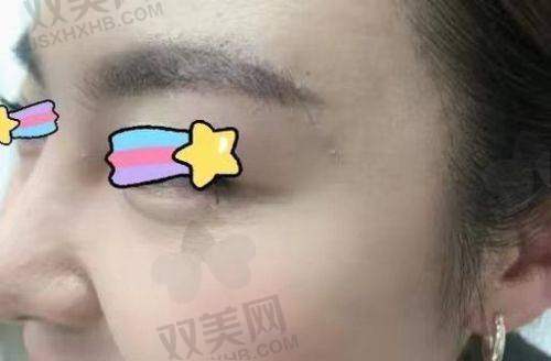 注射稀洛因馒化针的风险