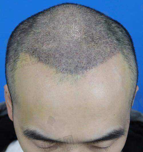 【西安锐逸植发医院是私立还是公办】