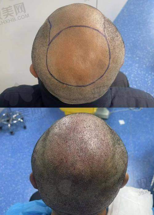 【西安科大植发医院是正规的吗】
