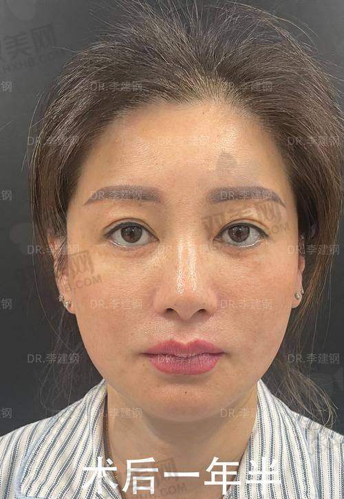 末尾总结：欧薇拉蛋白线值不值得做？有无避坑Tip？