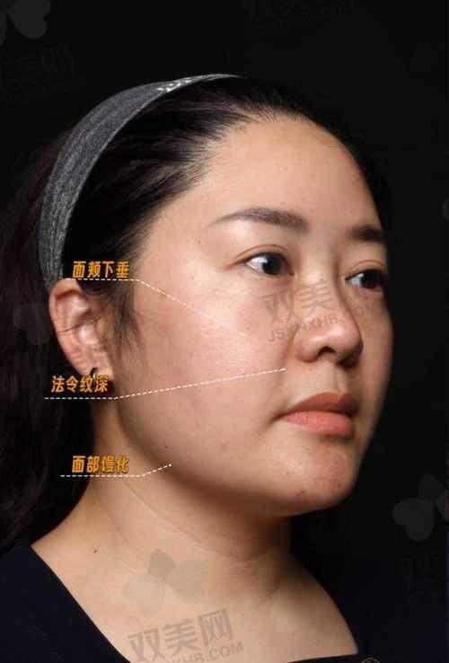 做欧薇拉疼吗？需要修复几天？