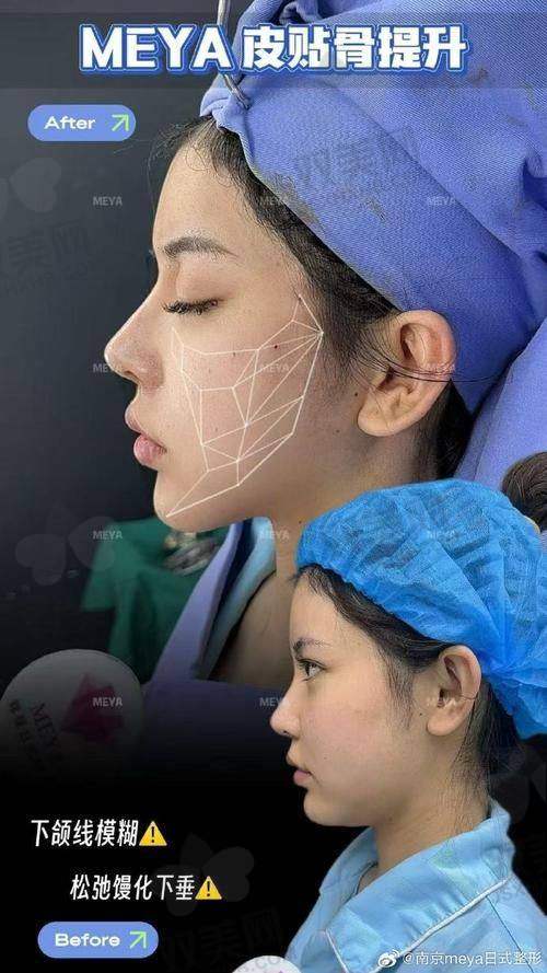 德国进口欧薇拉蛋白线到底是什么来头？单向倒刺？NO，是360°双向设计！