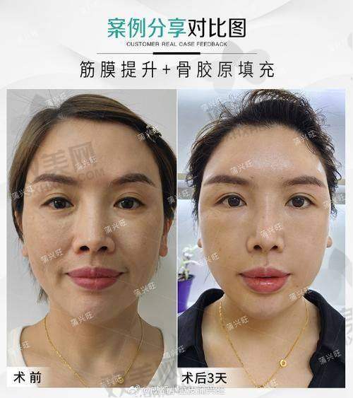 欧薇拉蛋白线价格表来啦！关键看“部位+数量+医生手法”