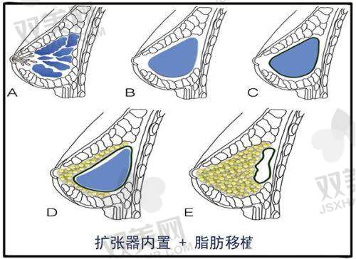 注射润致玻尿酸后要注意什么